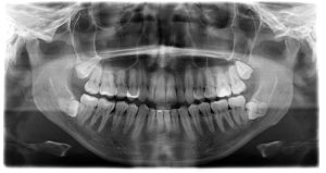wisdom teeth removal. panoramic film x ray dental.